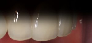 Esteettisellä hammashoidolla voidaan korjata värivirheitä. Kuvassa korjatut hampaat.